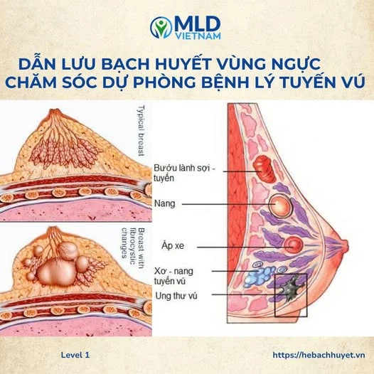 Chăm sóc và dự phòng các vấn đề tuyến vú bằng dẫn lưu bạch huyết
