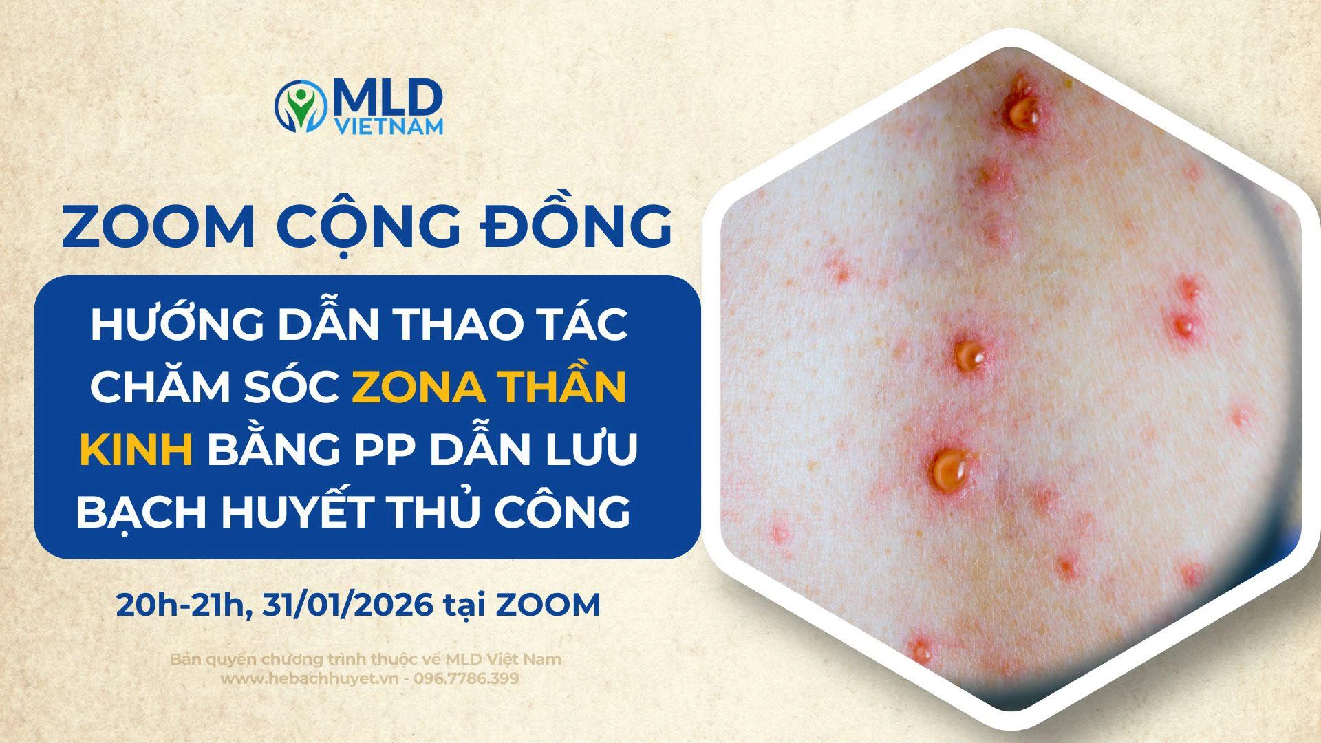 Zona thần kinh là bệnh gì? Góc nhìn thần kinh – miễn dịch – bạch huyết