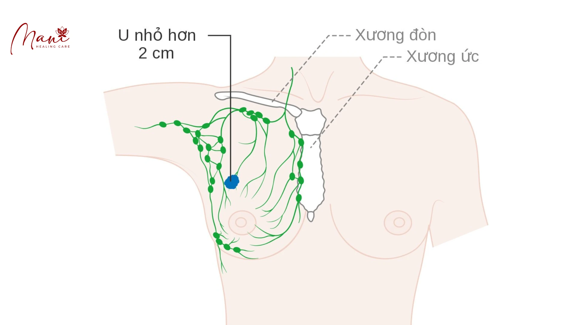 MỘT SỐ LƯƠNG THỰC, THỰC PHẨM CÓ KHẢ NĂNG PHÒNG CHỐNG UNG THƯ VÚ