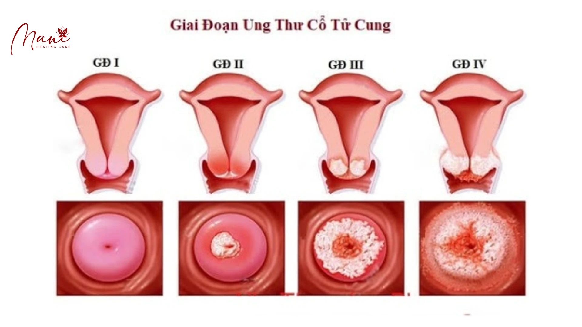 ĐẶC ĐIỂM UNG THƯ CÁC BỘ PHẬN SINH DỤC NỮ