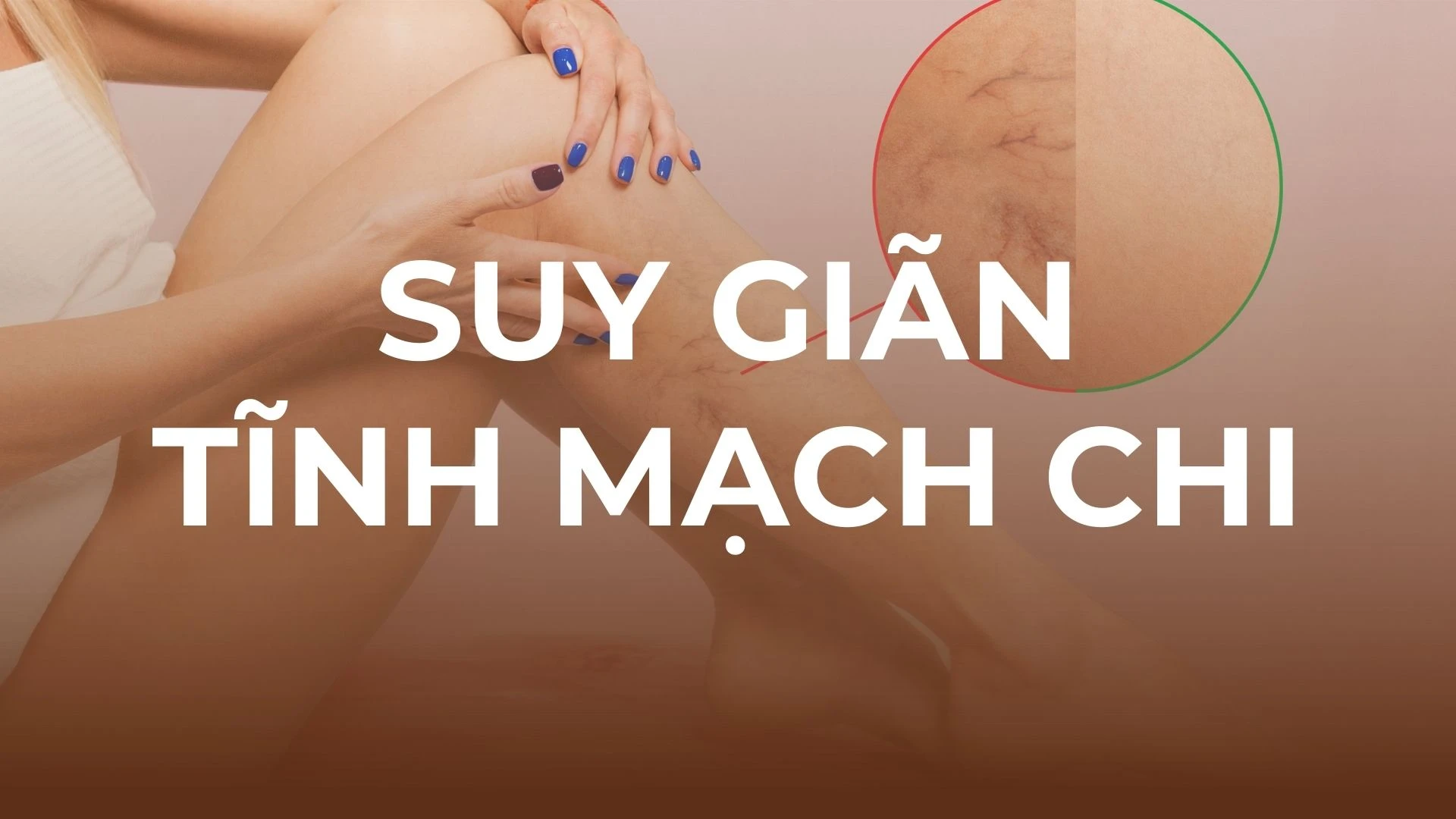 PHÁC ĐỒ CHĂM SÓC SUY GIÃN TĨNH MẠCH CHI