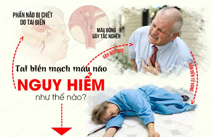 Đột quỵ là gì? Nguyên nhân, triệu chứng và dấu hiệu nhận biết sớm để kịp thời phòng ngừa