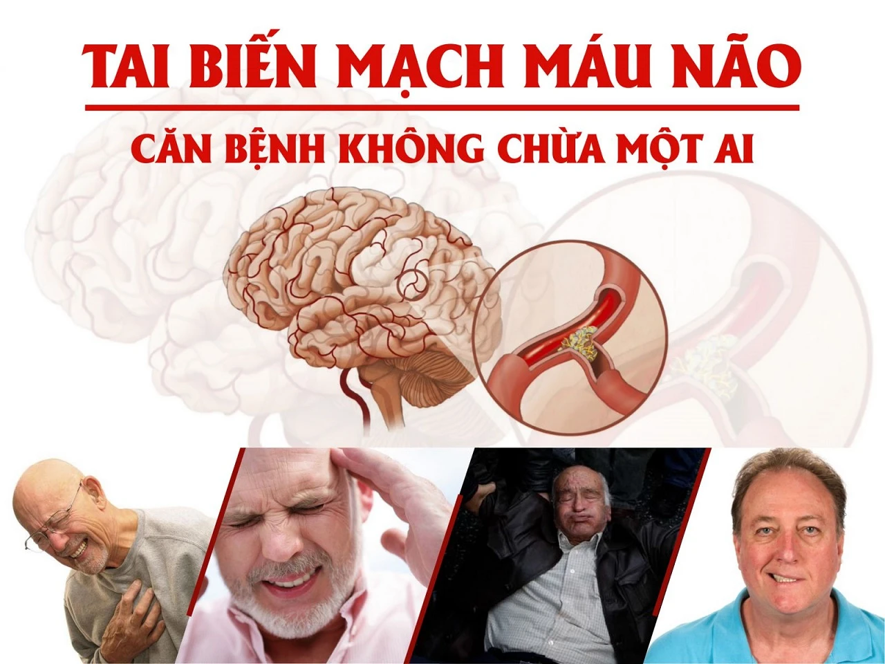 Chăm sóc bệnh nhân sau đột quỵ bằng dẫn lưu bạch huyết  Lưu ý quan trọng và giai đoạn áp dụng an toàn