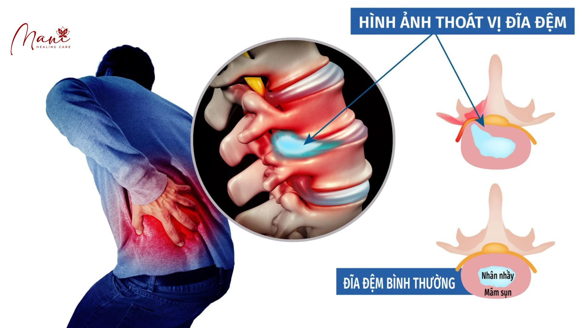 ĐẶC ĐIỂM CỦA THOÁT VỊ ĐĨA ĐỆM VÀ DẤU HIỆU NHẬN BIẾT