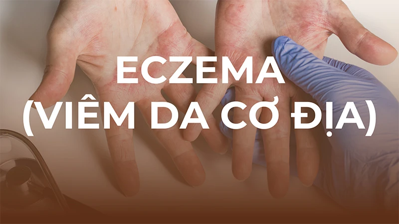 PHÁC ĐỒ CHĂM SÓC ECZEMA (VIÊM DA CƠ ĐỊA)