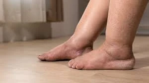 10 sự thật ít ai biết về phù sau phẫu thuật, liệt và tai biến