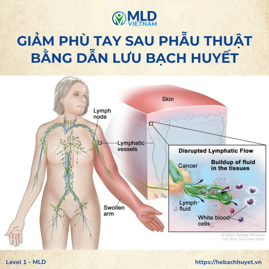 Vì sao phù tay sau nạo vét hạch giảm nhanh nhất bằng dẫn lưu bạch huyết (MLD)? Giải thích khoa học & phác đồ hiệu quả