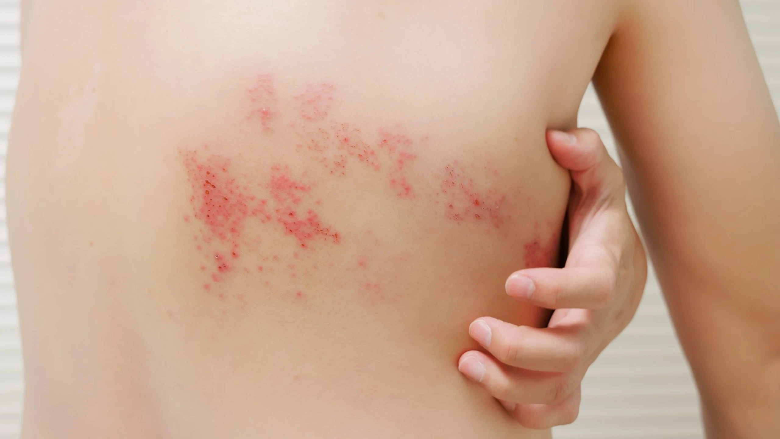 Dẫn lưu bạch huyết (MLD) hỗ trợ phục hồi sau zona thần kinh: đúng chuẩn, đúng thời điểm